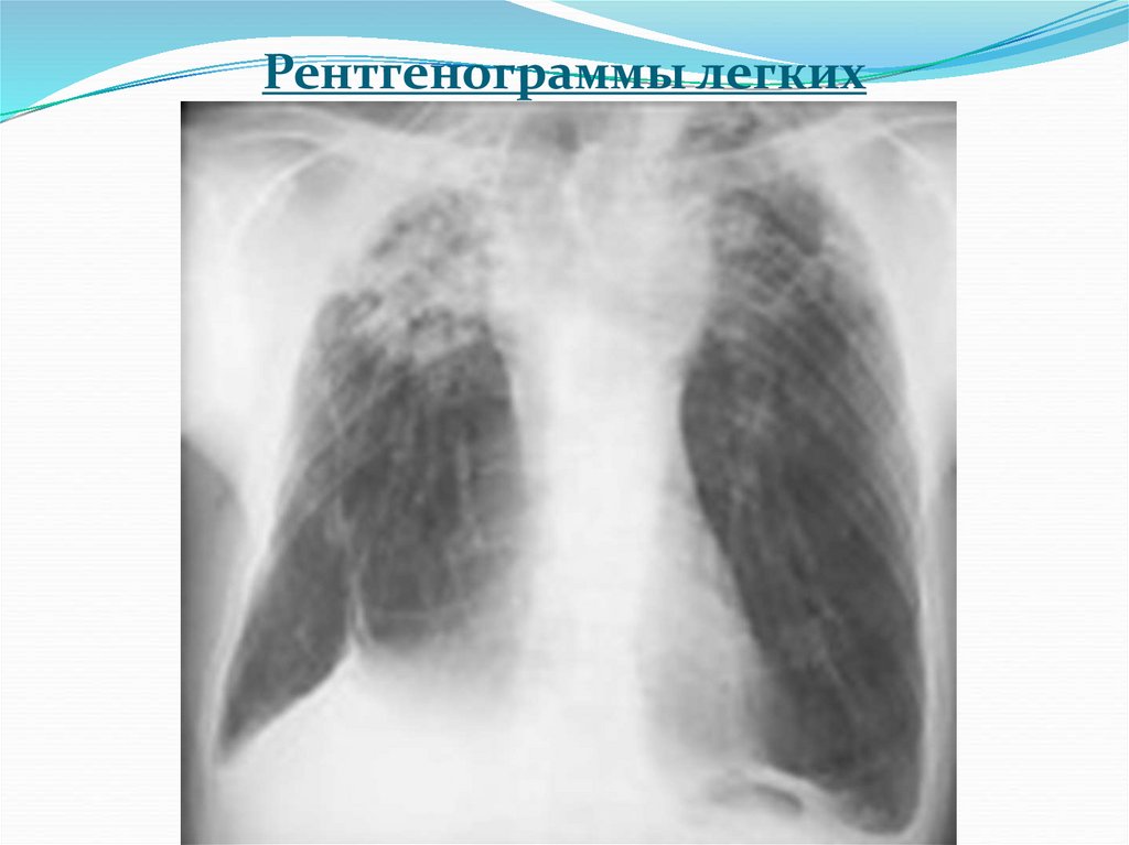 Рентгенограммы легких
