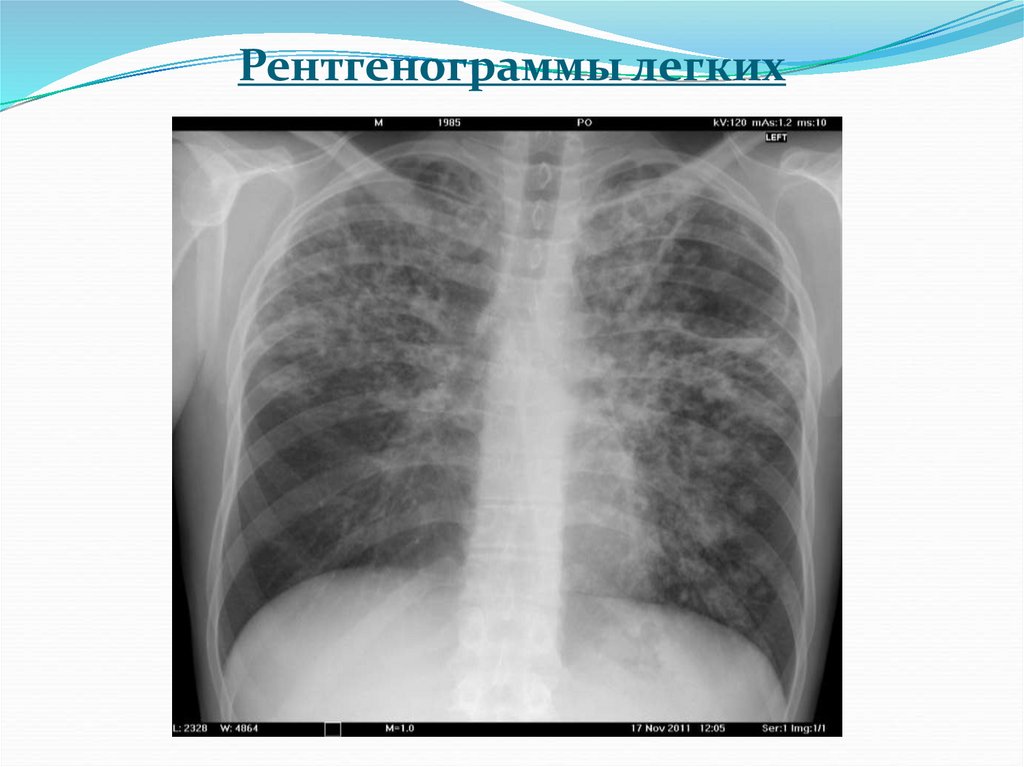Рентгенограммы легких