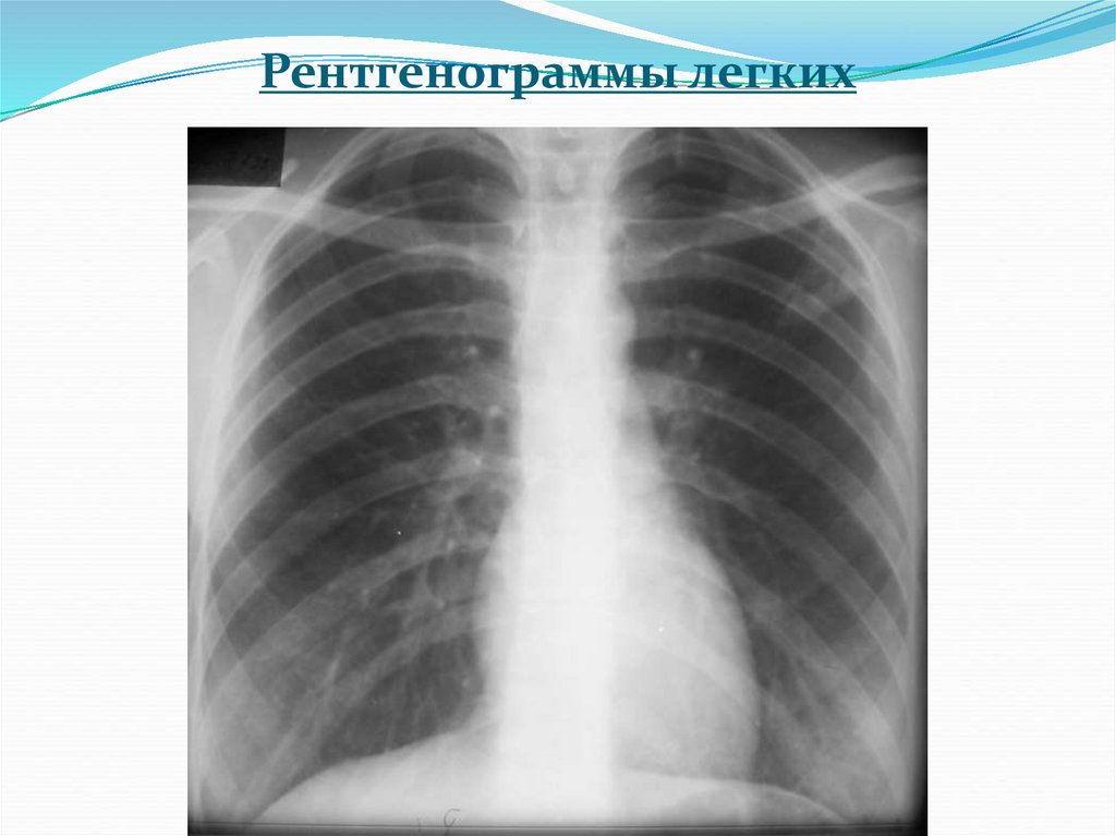 Снимок легких как называется. Мягкая рентгенограмма легких. Описание рентгенограммы легких. Учебные рентгенограммы легких. Результат рентгена легких.