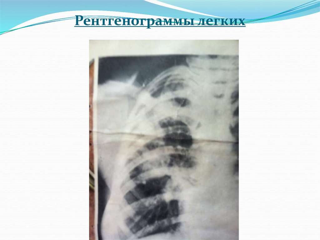 Рентгенограммы легких