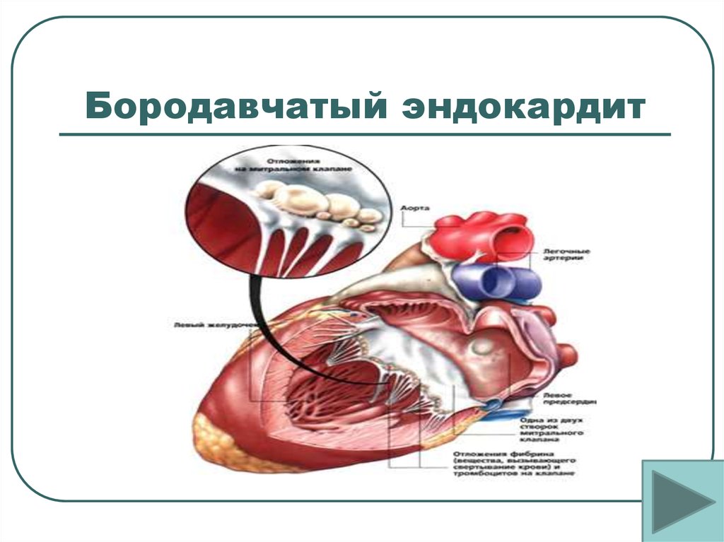 Эндокардит миокардит перикардит