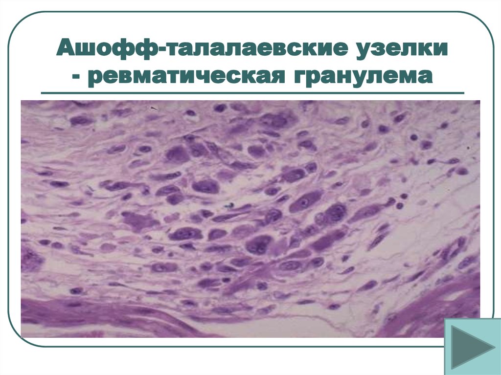 Ашофф талалаевская гранулема