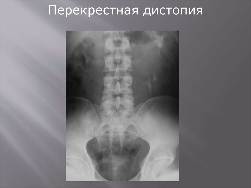 Нефроптоз дистопия. Перекрестная дистопия почки. Гомолатеральная дистопия почки. Подвздошная дистопия почки рентген. Гетеролатеральная перекрестная дистопия почки.