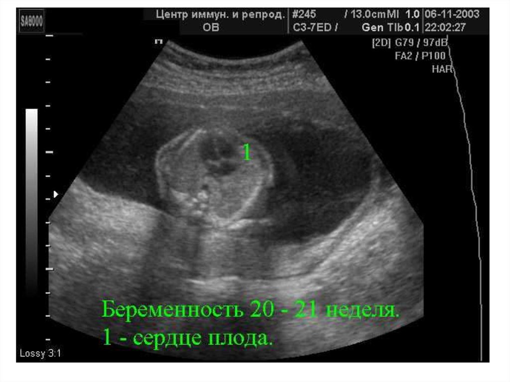 Эхо кг плода при беременности. УЗИ сердца плода. Сердце эмбриона по неделям УЗИ. Эхокардиография плода. Сердечко эмбриона на УЗИ.