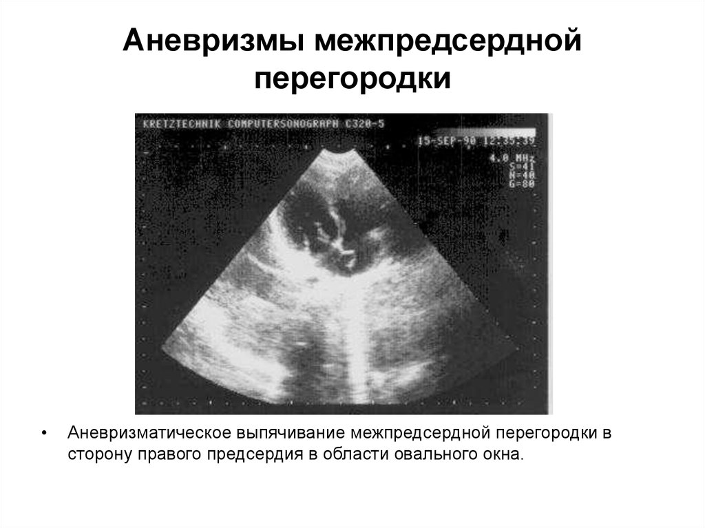 Аневризма межпредсердной перегородки. Эхокардиография аневризма МПП. Аневризма МПП на ЭХОКГ. Аневризма МЖП на УЗИ. Аневризма выбухания МПП.