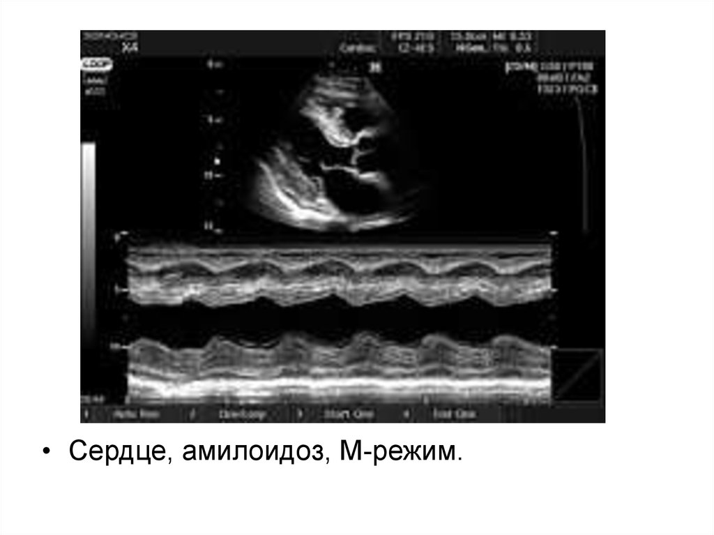М режим. Амилоидоз сердца ЭХОКГ. ЭХОКГ сердца в м-режиме. М режим УЗИ. Режимы УЗИ диагностики.