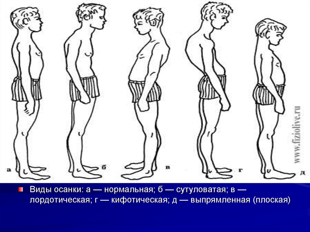 Виды осанки. Кифотическая лордотическая. Лордотическая осанка. Кифотический Тип осанки. Кифосколиотическая осанка.