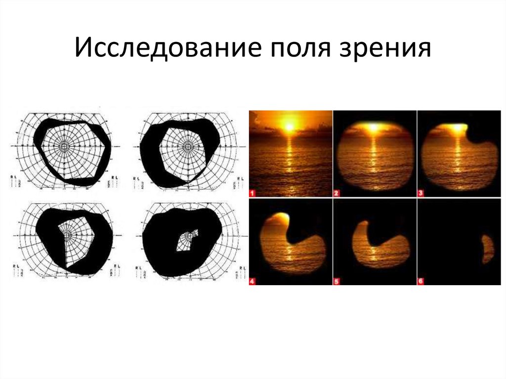 Исследование полей зрения