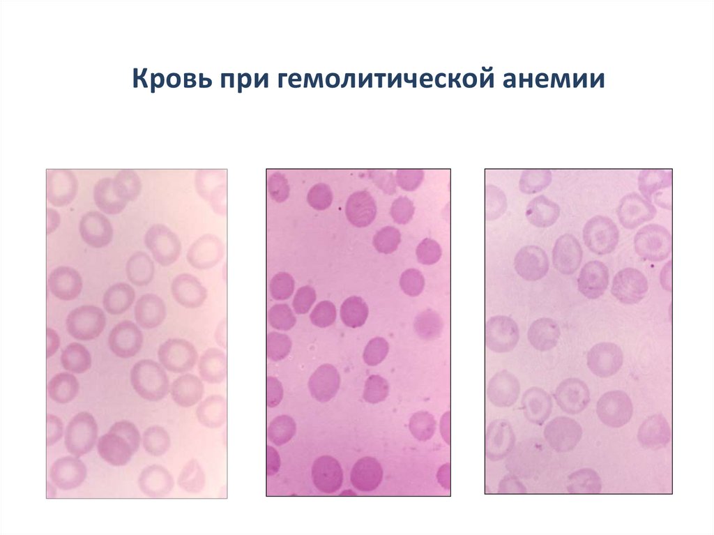 Гемолитический шок. Язык при гемолитической анемии. Гемолитическая анемия клиника. Ретикулоцитоз. Стоматоцитарная гемолитическая анемия.