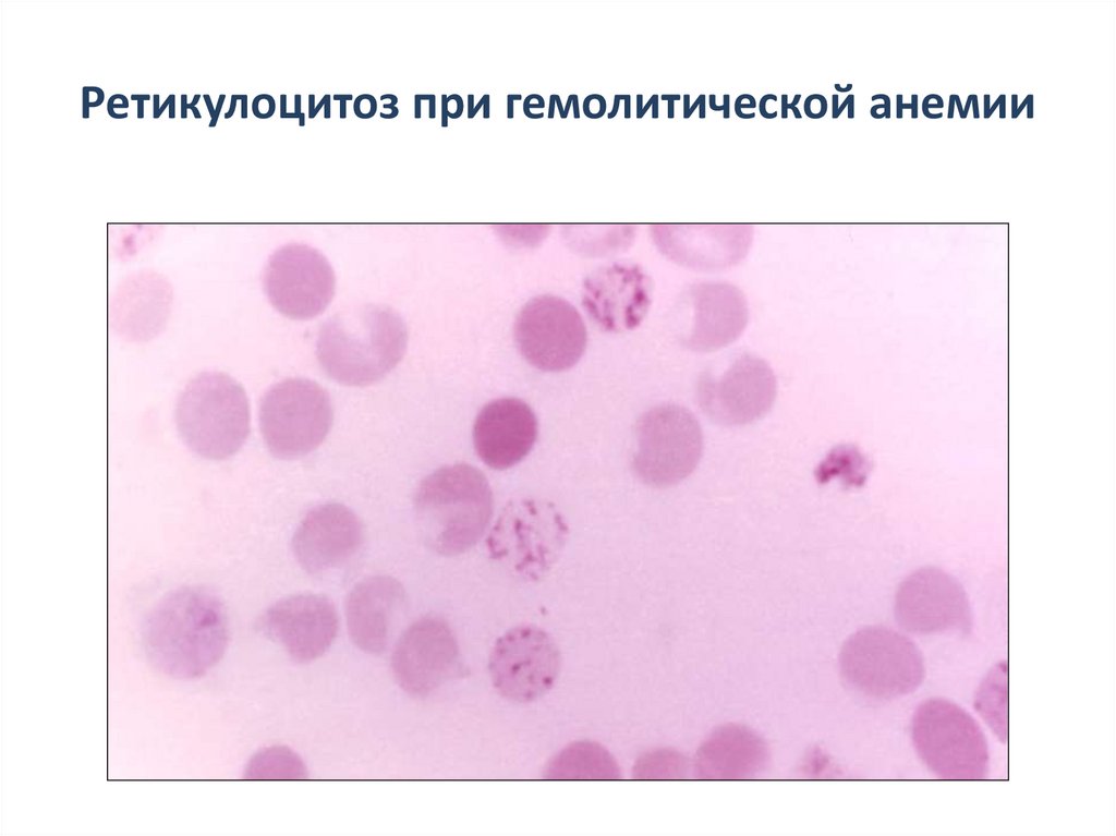 Гемолитическая анемия картина крови