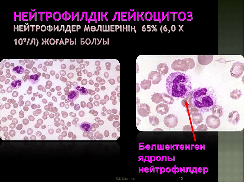 5 лейкоцитоз. Умеренный лейкоцитоз. Лейкоцитоз микроскопия. Ложный лейкоцитоз. Абсолютный нейтрофильный лейкоцитоз.