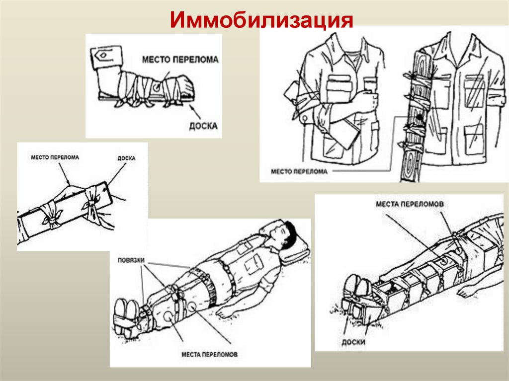 Первая помощь при ушибах и растяжениях вывихах и переломах 9 класс презентация