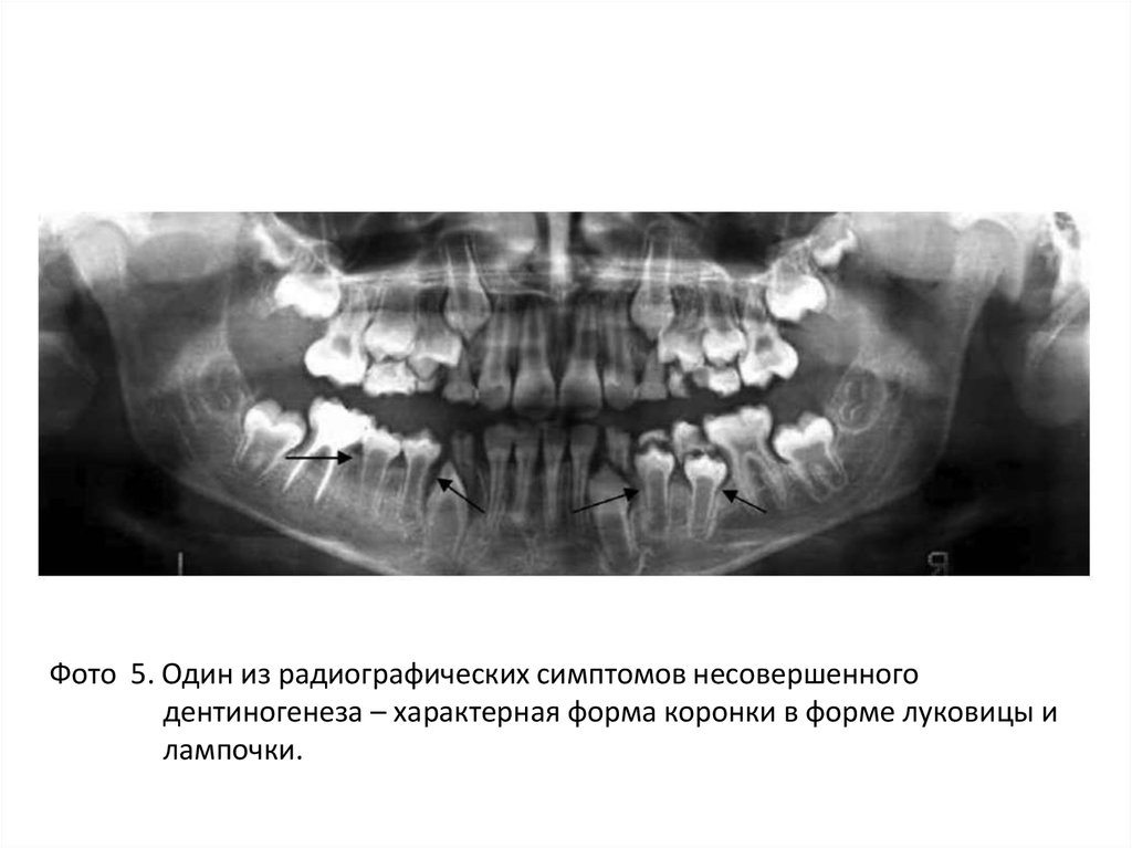 Синдром стентона капдепона фото