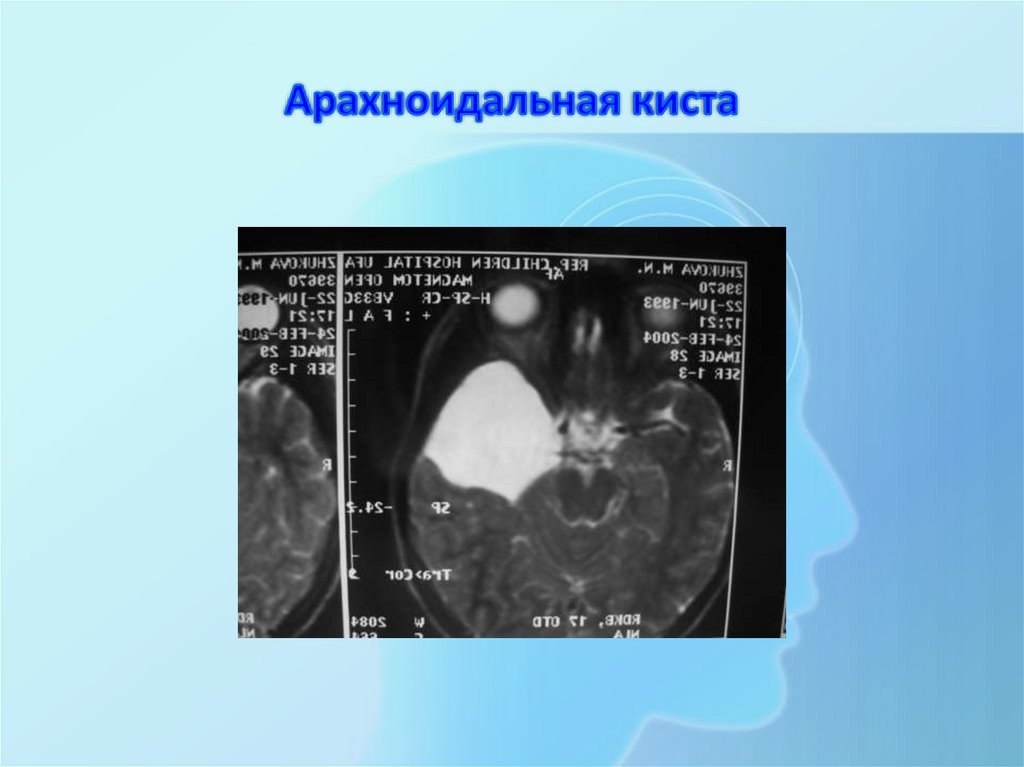 Арахноидальная киста левой височной доли. Арахноидальная киста 107*49*28. Арахноидальная киста на УЗИ. Арахноидальная киста гидроцефалия. Парасагиттальная арахноидальная киста.