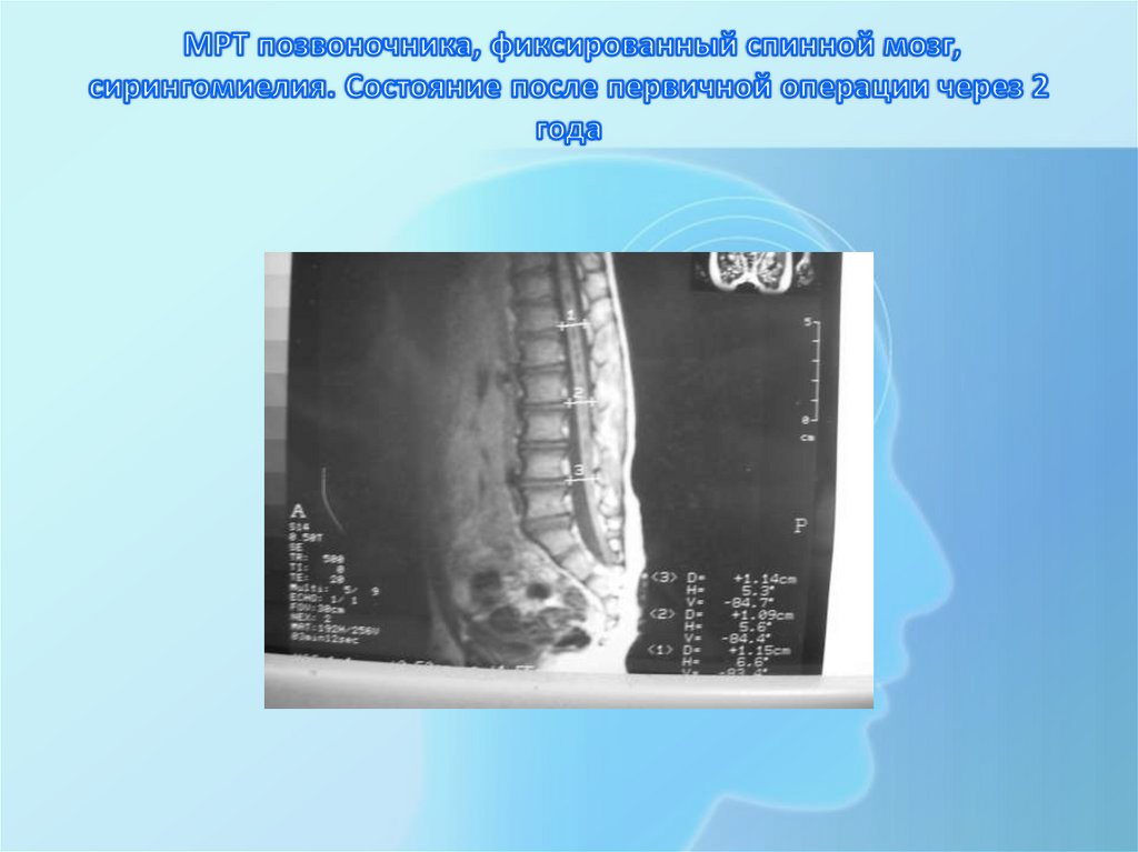 Фиксированный спинной. Фиксированный спинной мозг мрт. Синдром фиксированного спинного мозга. Синдром фиксированного спинного мозга мрт. Синдром фиксированного спинного мозга у детей.