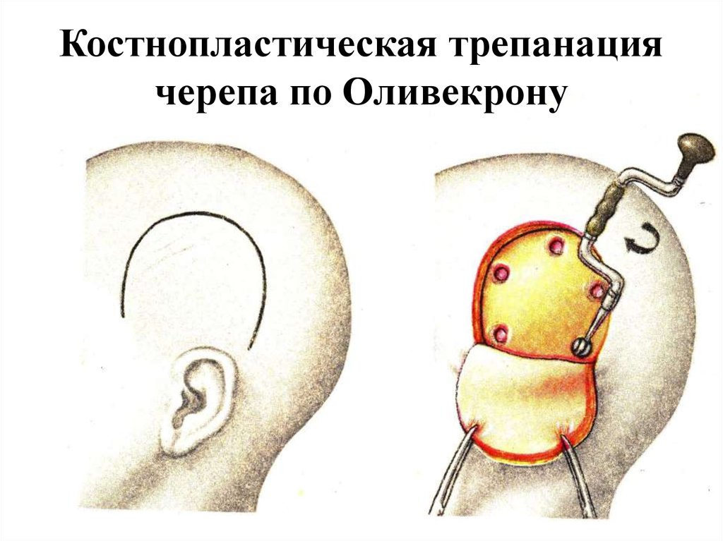 Трепанация по оливекрону