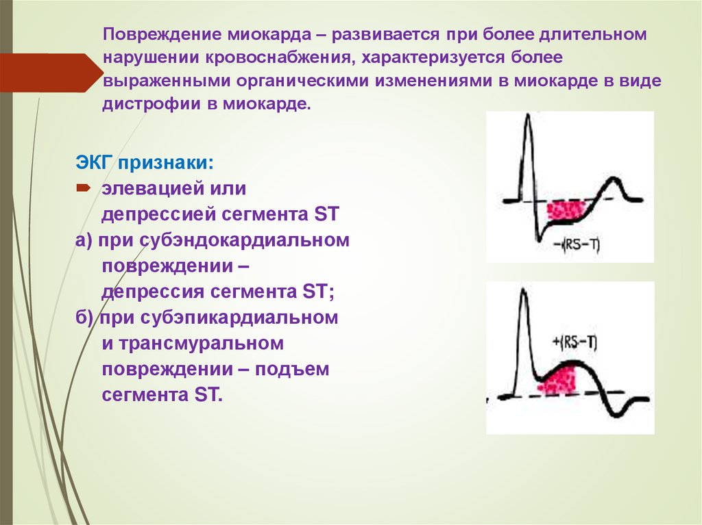 Основным экг признаком некроза сердечной мышцы является. ЭКГ критерии повреждения миокарда. Ишемическое повреждение миокарда на ЭКГ проявляется. Острая ишемия миокарда на ЭКГ. Признаки повреждения миокарда на ЭКГ.