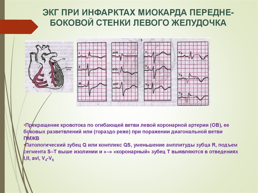 Изменения боковых отделов. ЭКГ острый инфаркт миокарда передне боковой. Инфаркт миокарда переднебоковой стенки. Инфаркт миокарда передне-боковой стенки. ЭКГ инфаркт передней боковой стенки.