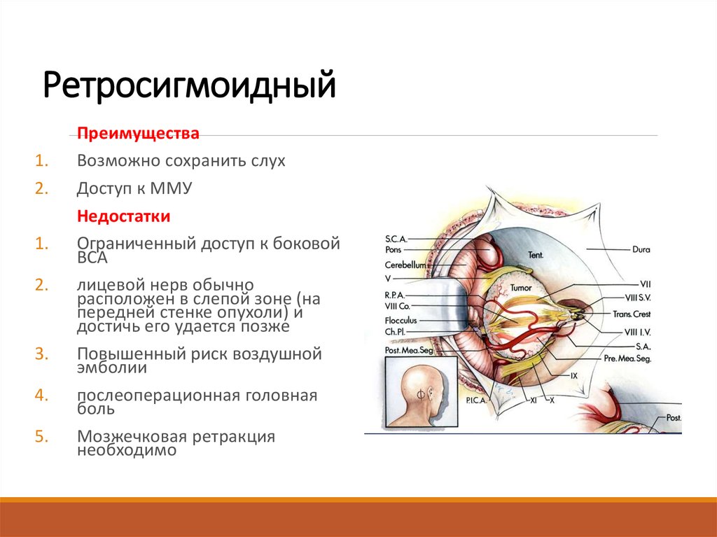 Мосто мозжечковый синдром