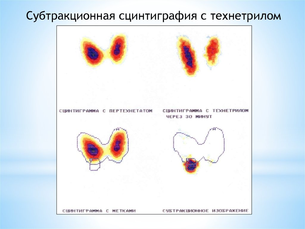 Сцинтиграфия железы. Сцинтиграфия паращитовидной железы. Аденома паращитовидной железы на сцинтиграфии. Сцинтиграфия щитовидной железы с технетрилом. Гиперпаратиреоз сцинтиграфия.