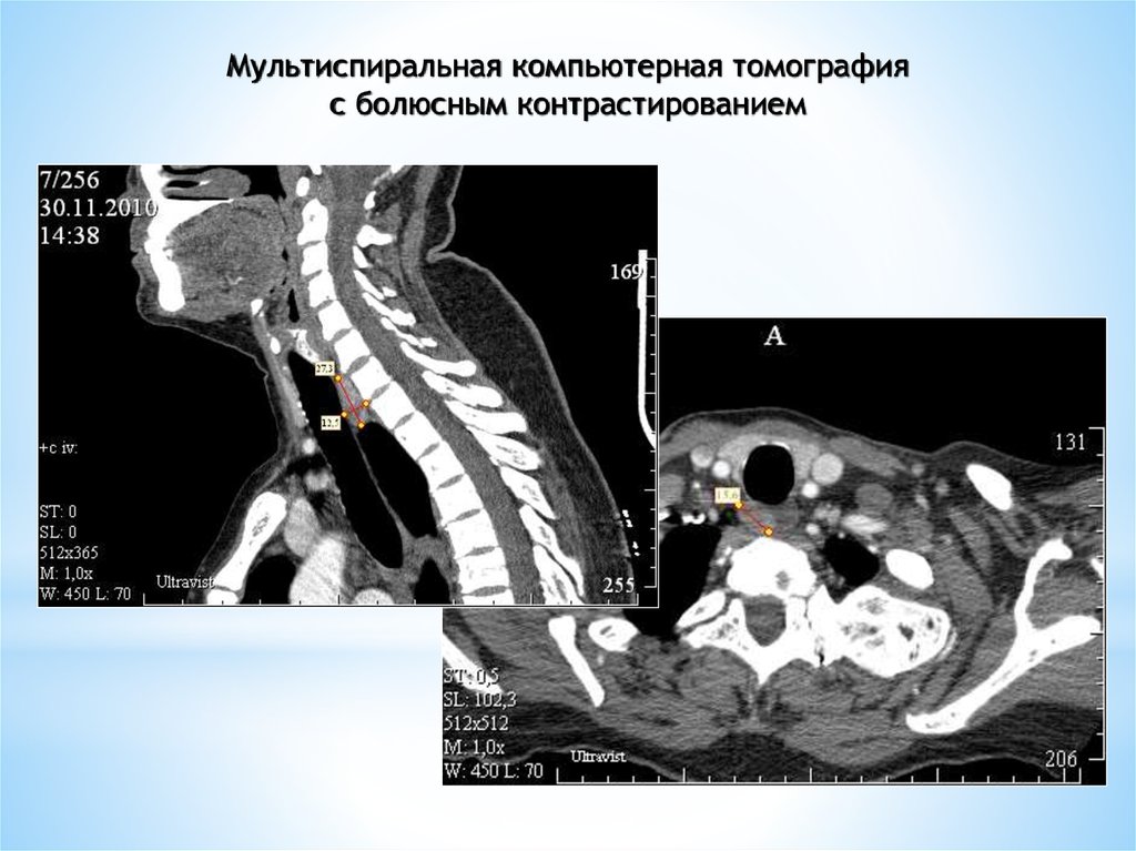 Мскт с контрастированием. Компьютерная томография с болюсным контрастированием. Кт с болюсным контрастированием что это. МСКТ болюсное контрастирование. Спиральная компьютерная томография с болюсным контрастированием.