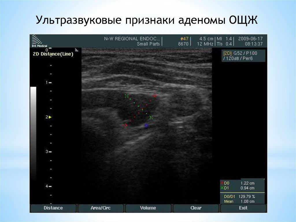 Аденома паращитовидных желез