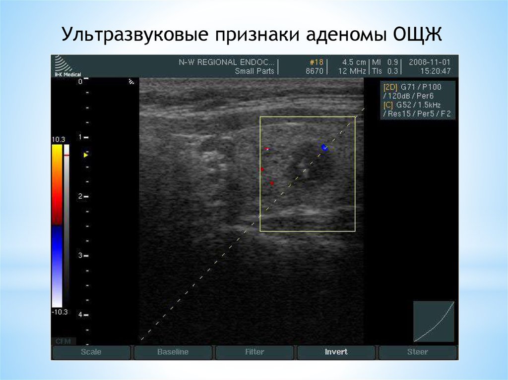 Аденома паращитовидной железы. Паращитовидные железы по УЗИ.