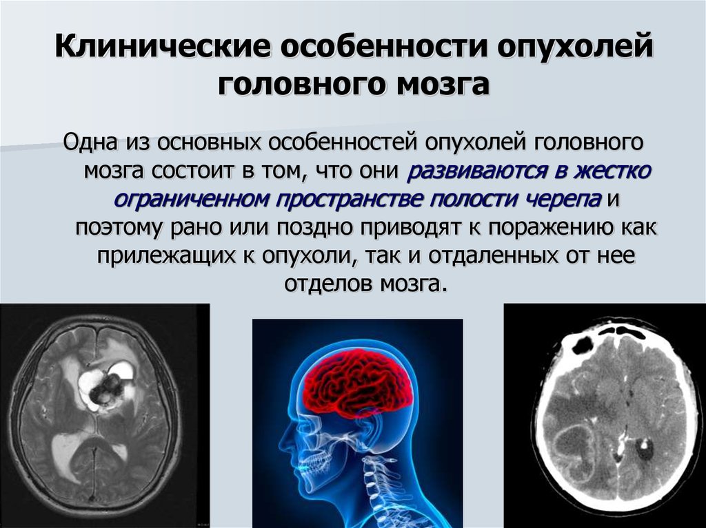 Виды опухолей головного. Опкхолльлголовного мозга. Новообразование в головном мозге. Злокачественная опухоль головного мозга.