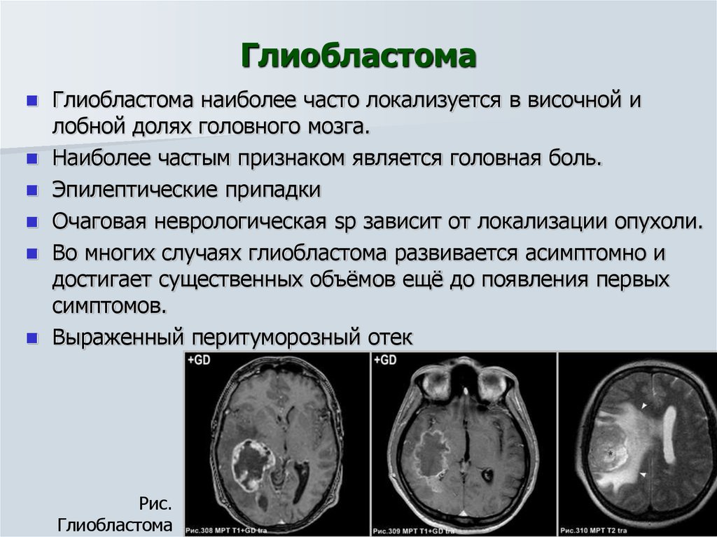 Симптомы онкологии головного мозга. Глиобластома мультиформная степень 4. Неоперабельная глиобластома головного мозга.. Опухоль головного мозга глиобластома 4. Глиобластома лобной доли мрт.