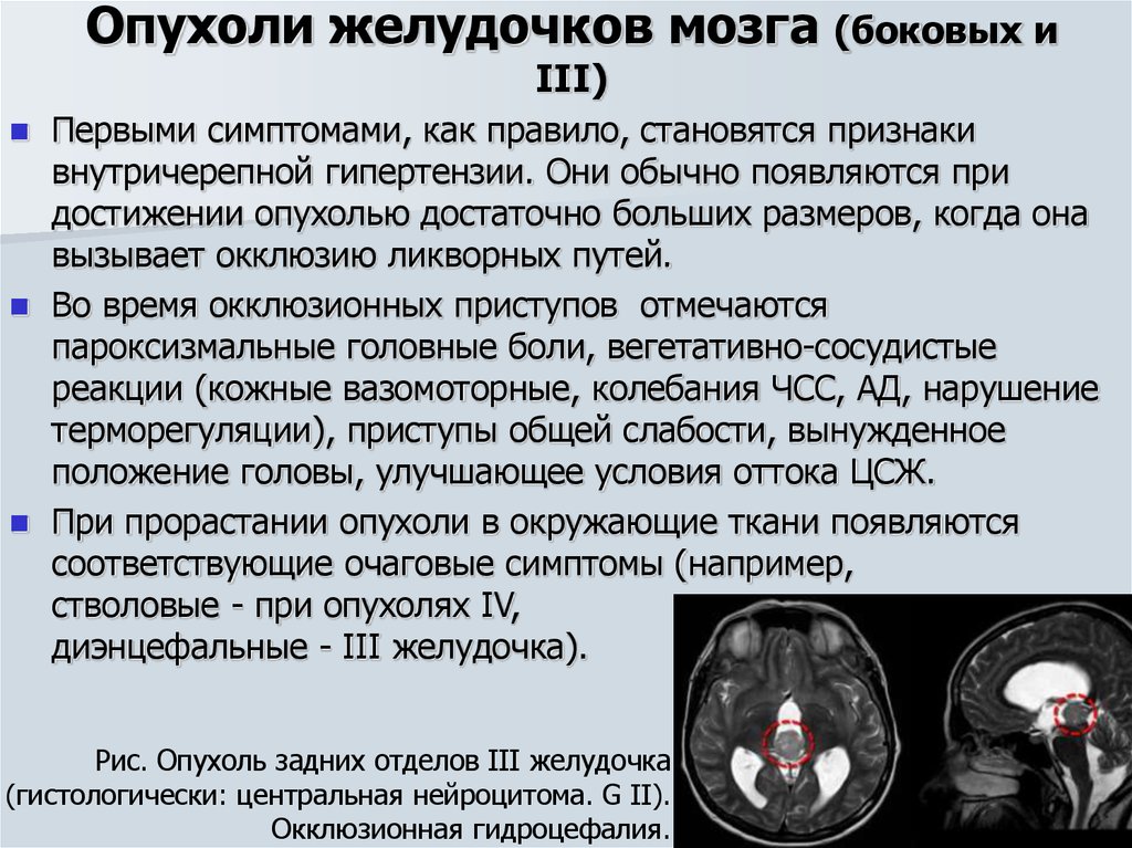 Рак мозга сколько стадий. Опухоль головного мозга симптомы. Локализация опухолей головного мозга. Опухоль желудочка головного мозга. Опухоли головного мозга сим.
