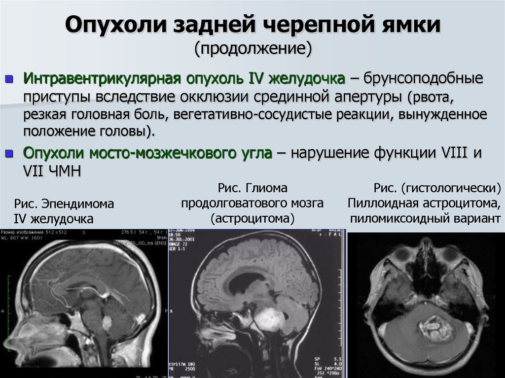 Опухоли гм. Диагностические критерии глиомы головного мозга. Объемное образование головного мозга. Локализация опухолей головного мозга. Первичные и вторичные опухоли головного мозга.