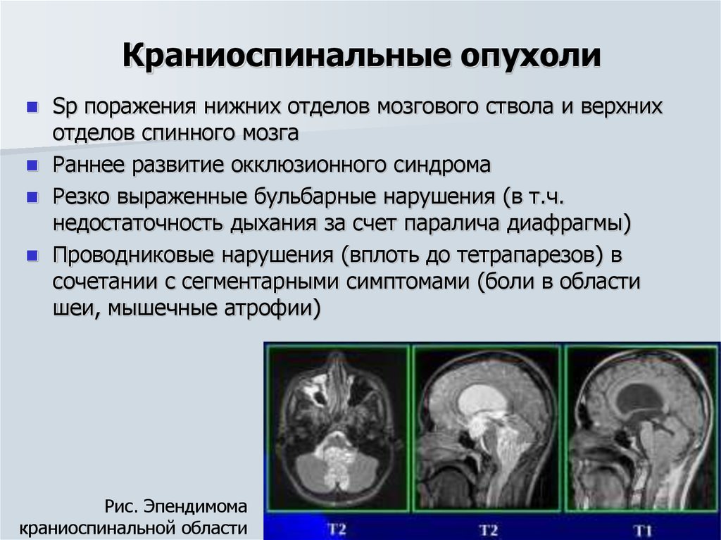 Виды опухолей головного. Краниоспинальные опухоли. Опухоли головного мозга презентация. Клинические проявления опухолей головного и спинного мозга. Презентация опухоль мозга.