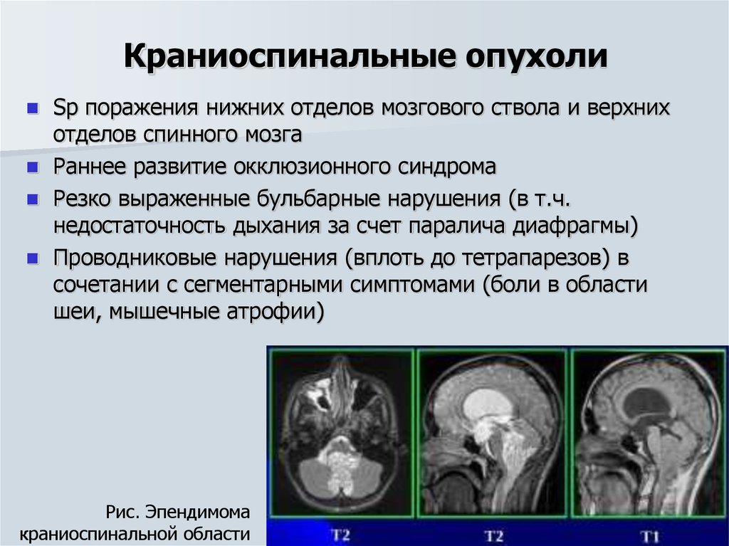 Опухоль мозга презентация