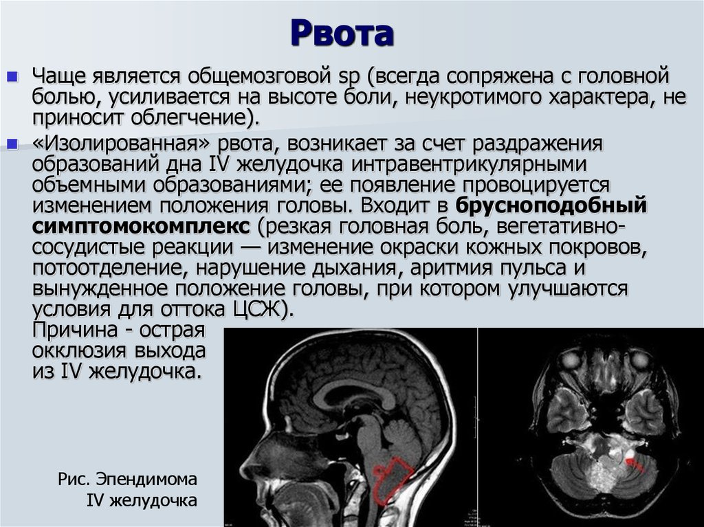 Опухоль головного мозга это. Синдромы опухолей головного мозга. Опухоли желудочков мозга. Объемное образование головного мозга. Синдромы при опухолях головного мозга.