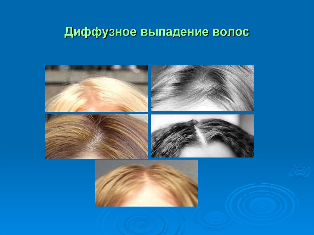 Чем отличается диффузное выпадение волос от андрогенного
