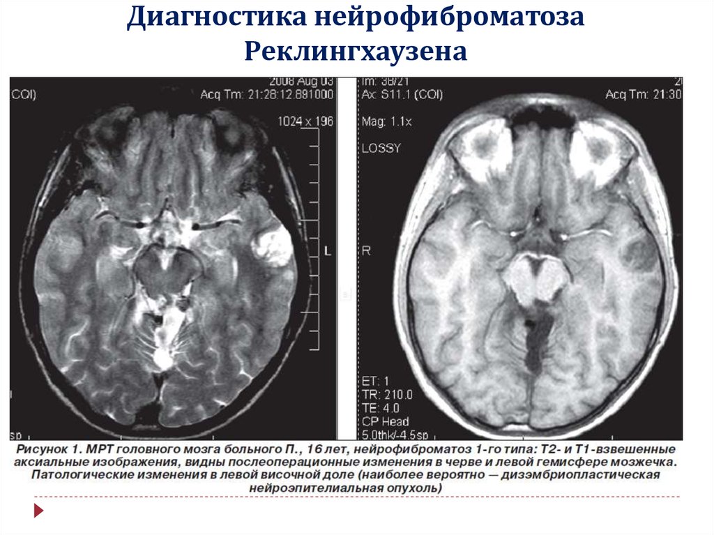Синдром фона. Нейрофиброматоз 1 типа мрт головного мозга. Нейрофиброматоз мрт головной мозг. Нейрофиброматоз головного мозга кт. Нейрофиброматоз (незлокачественный).