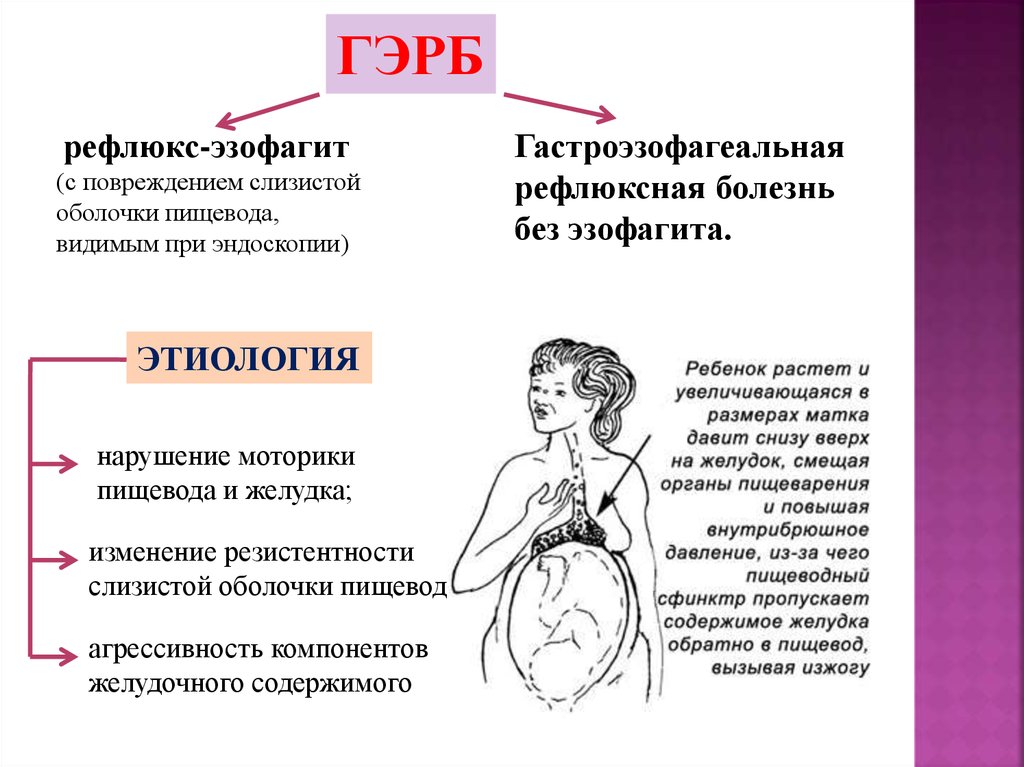 Рефлюкс при беременности. Газоэзофагальнаярефлюксная болезнь. Заболевание органов пищеварения у беременных.