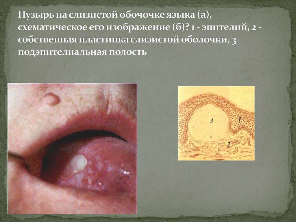Пузырь на слизистой обочочке языка (а), схематическое его изображение (б)? 1 - эпителий, 2 - собственная пластинка слизистой