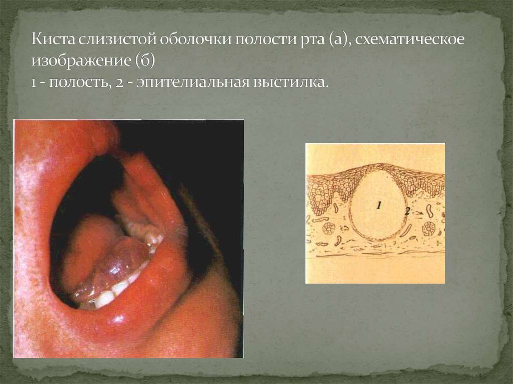 Киста слизистой оболочки полости рта (а), схематическое изображение (б) 1 - полость, 2 - эпителиальная выстилка.