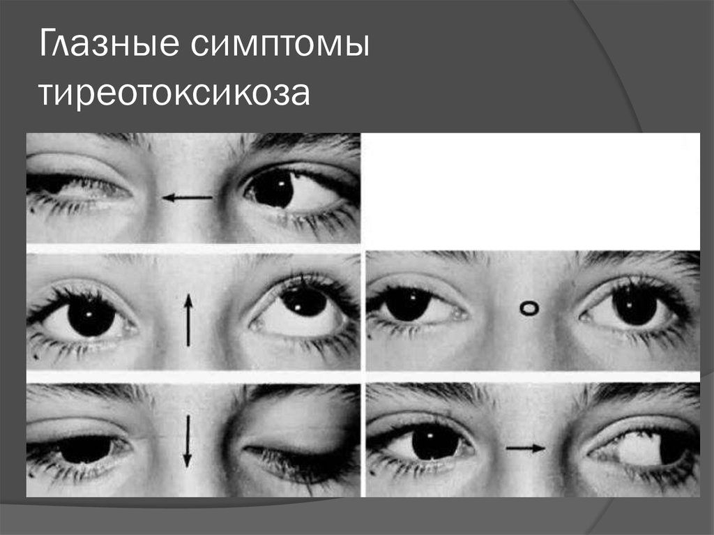 Глаза признак. Симптомы Грефе Мебиуса Штельвага. Симптомы Грефе, Мебиуса, кохера. Симптом Грефе тиреотоксикоз. Симптом кохера при тиреотоксикозе.
