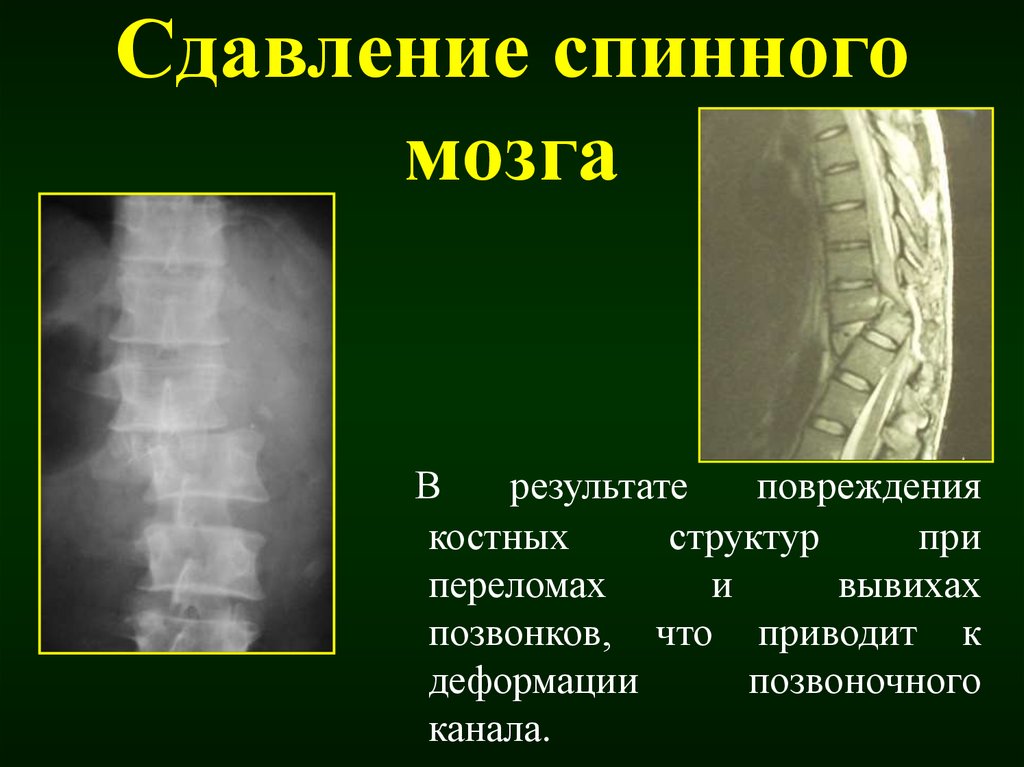 Травмы позвоночника с повреждением. Сдавление спинного мозга. Перелом позвоночника с повреждением спинного мозга. Травма позвоночника с повреждением спинного мозга.