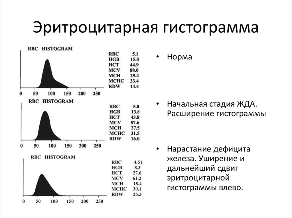 Ширина распределения по объему. Гистограмма гематологического анализатора. Гистограммы распределения эритроцитов, лейкоцитов, тромбоцитов.. Эритроцитарная гистограмма в норме и при патологии. Гистограмма эритроцитов в норме.