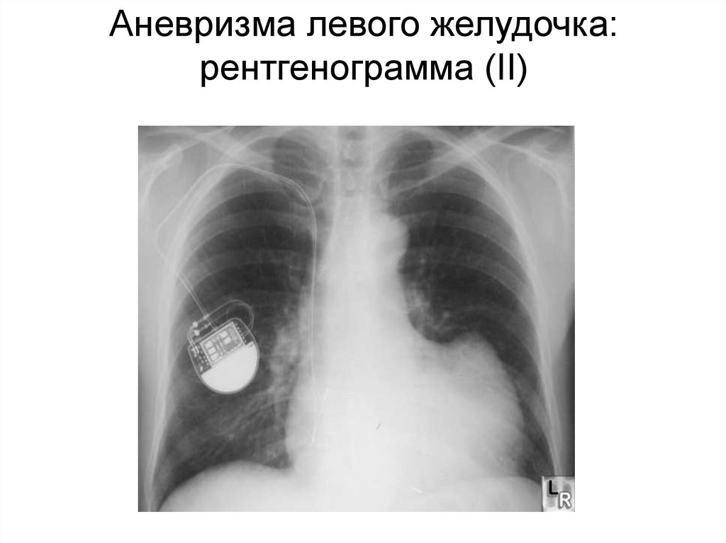 Аневризма левого желудочка: рентгенограмма (I)