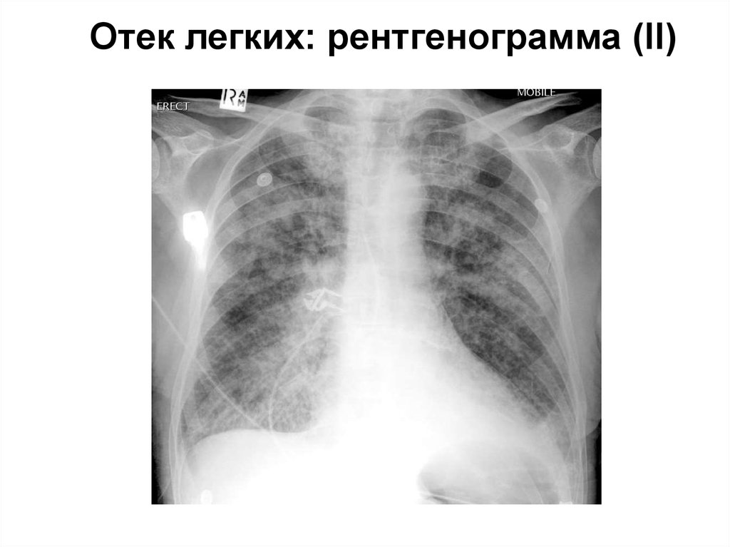 Отечность легких. Некардиогенный отек легких рентгенограмма. Уремическая пневмония рентген. Отек легких рентген.