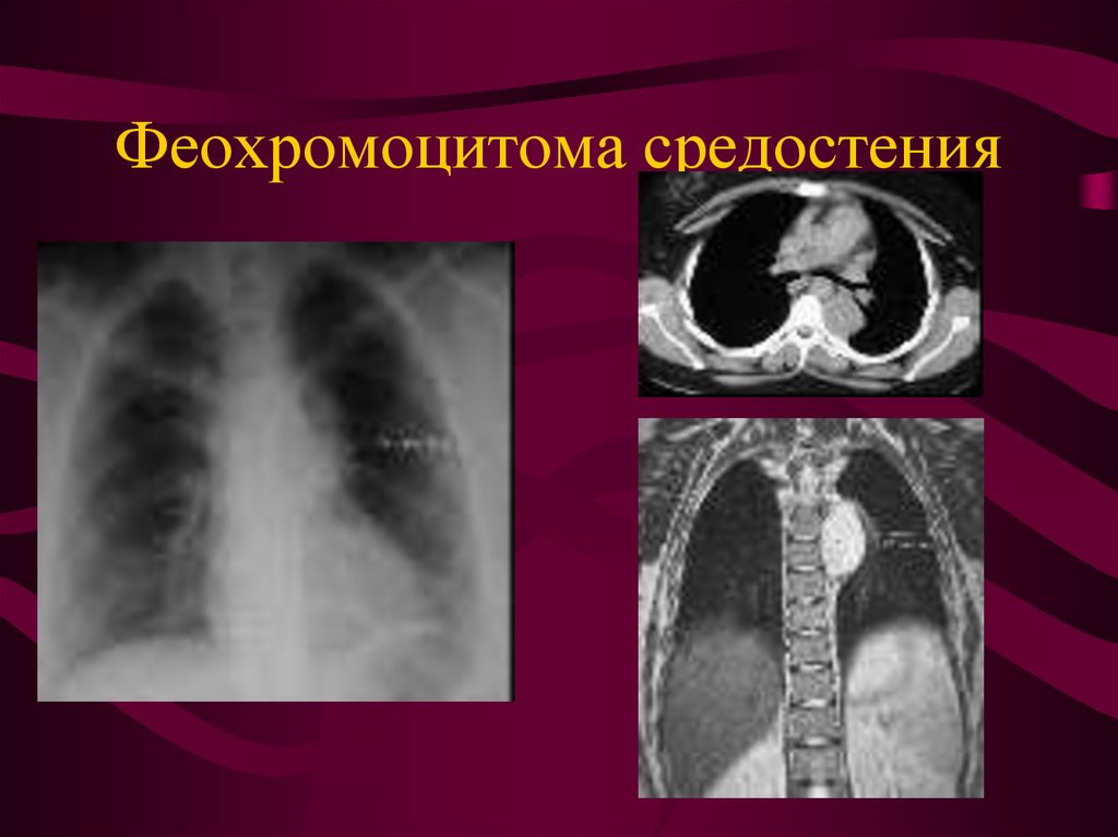 Феохромоцитома. Шваннома средостения кт. Невринома средостения на рентгене. Феохромоцитома средостения.