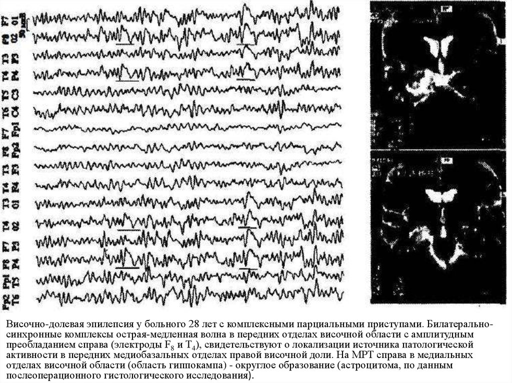 Ээг показывает эпилепсию. Височно долевая эпилепсия. Криптогенная фокальная эпилепсия ЭЭГ. Височная эпилепсия на ЭЭГ. Эпилепсия на мрт.
