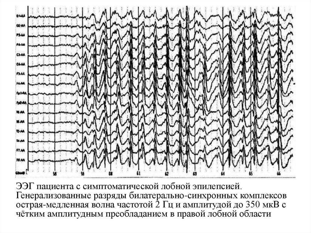 Острые волны на ээг. ЭЭГ эпилепсия пик-волна. Комплекс острая медленная волна на ЭЭГ. Комплексы пик волна на ЭЭГ. ЭЭГ при эпилепсии пик волна.