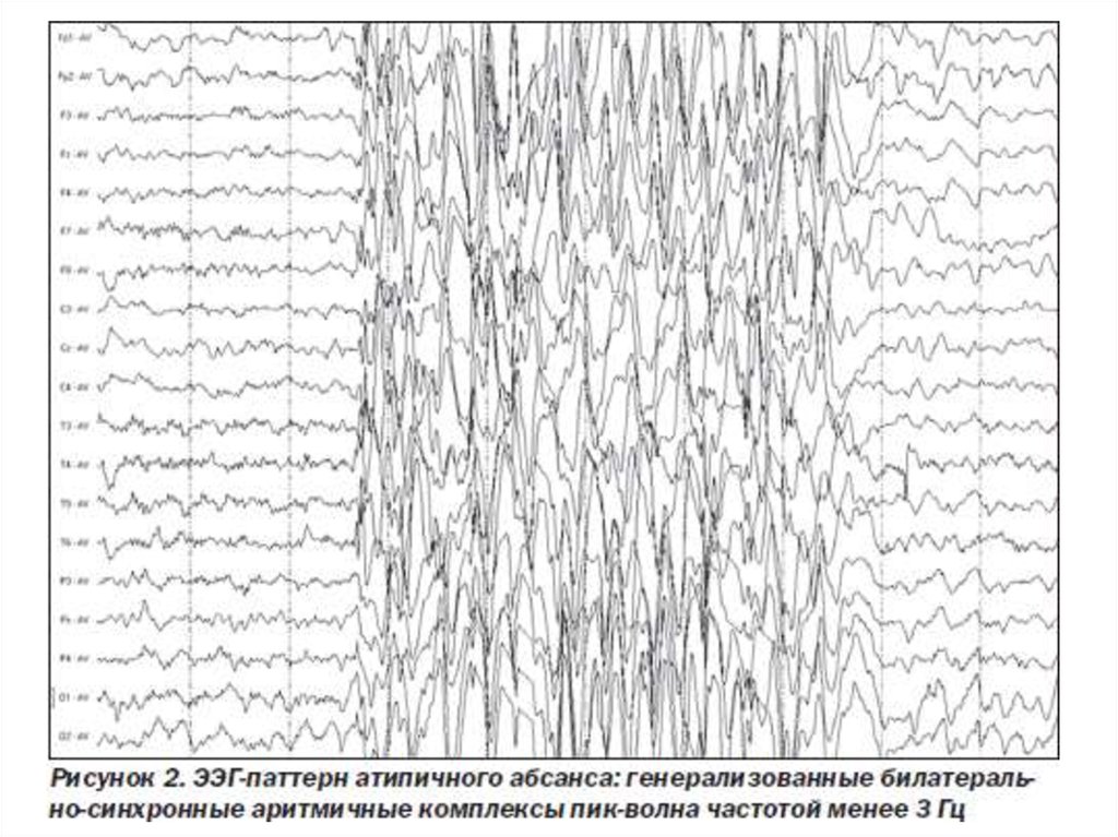 Ээг показывает эпилепсию. Генерализованная эпилепсия ЭЭГ. ЭЭГ эпилепсия пик-волна. Эпилептиформные паттерны на ЭЭГ. ЭЭГ больного эпилепсией.