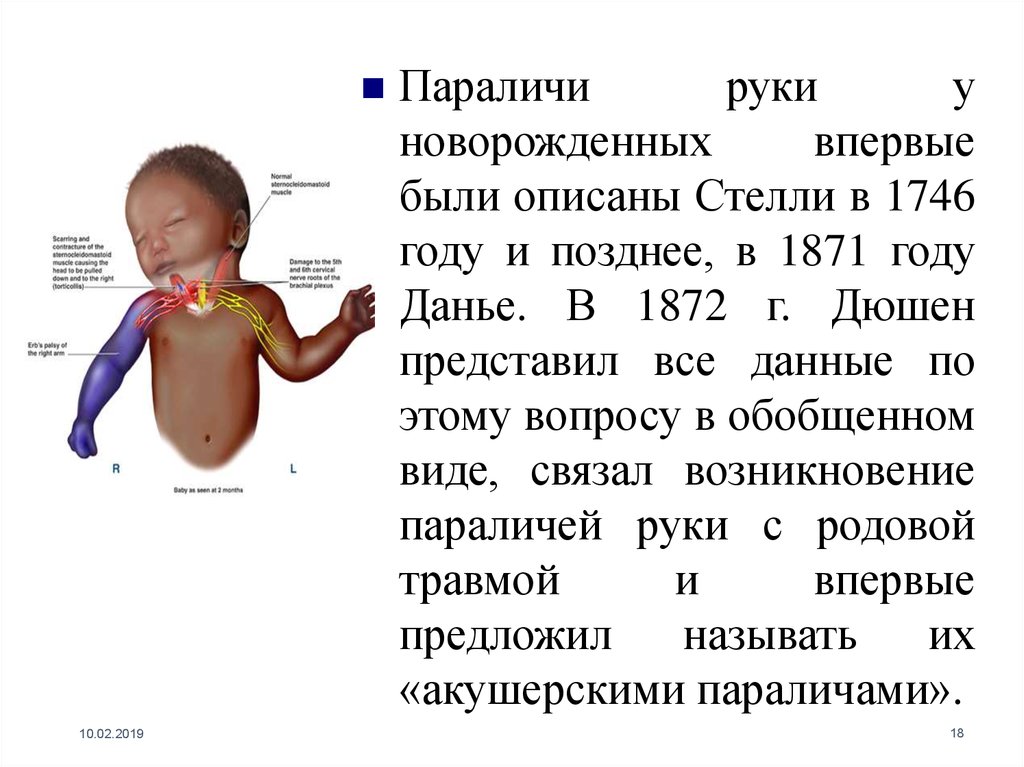 Парез руки. Парез руки у новорожденного. Монопарез левой руки у грудничка.