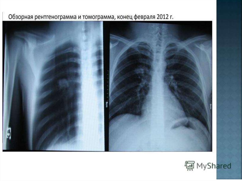 Туберкулома легких картинки